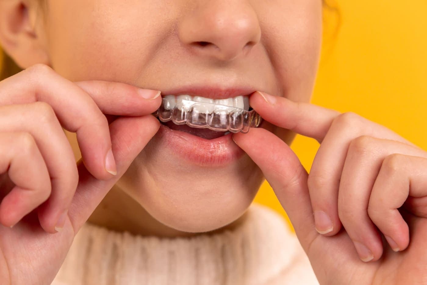 Dental example post: Straighter, in months, not years